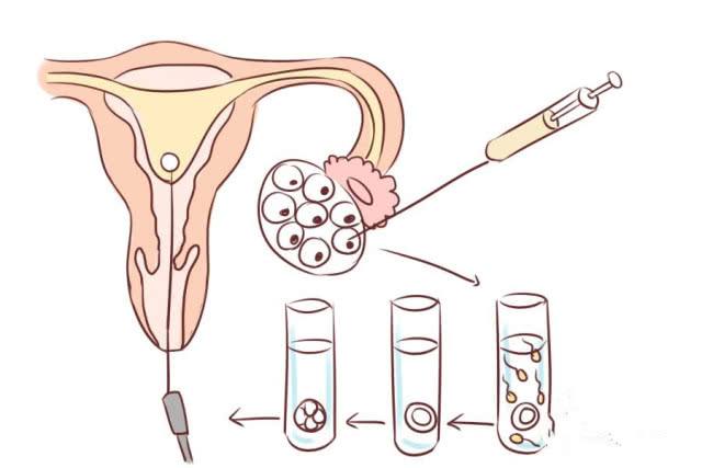 试管婴儿促排前，女性应该如何调理？